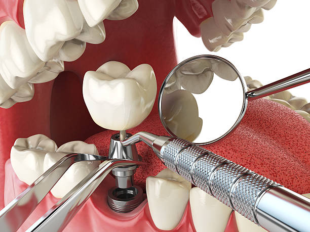 Best Emergency Dental Care for Broken or Chipped Teeth in Stratford, CA